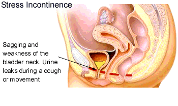 Incontinence / Overactive Bladder - Urological Health Topics - Tracy and Manteca