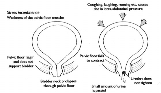 Stress Incontinence - In Office Urological Procedure - Tracy and Manteca